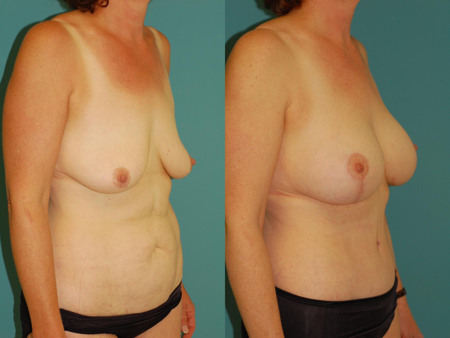 Before & After Standard Breast Lift with Implants Case 27 View #3 View in Ellicott City, MD