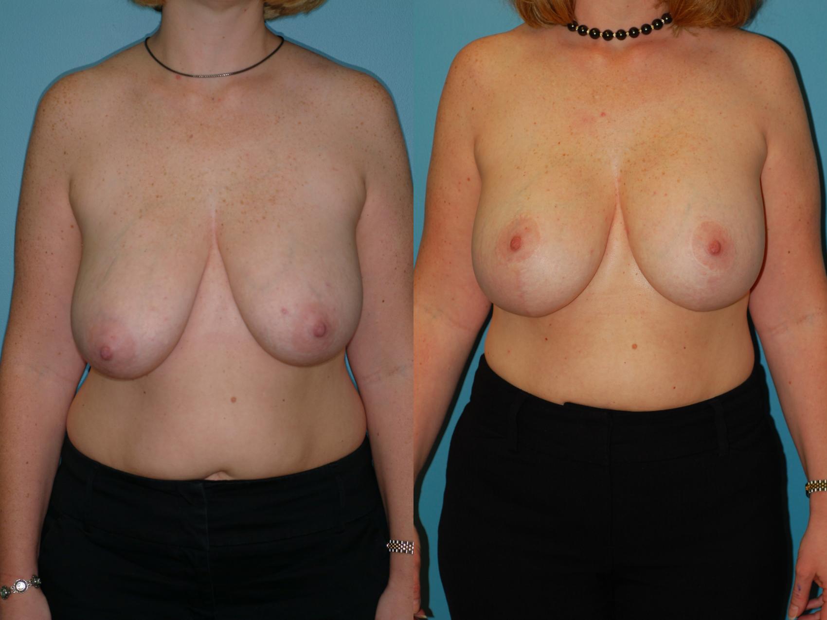 Before & After Standard Breast Lift with Implants Case 28 View #1 View in Ellicott City, MD