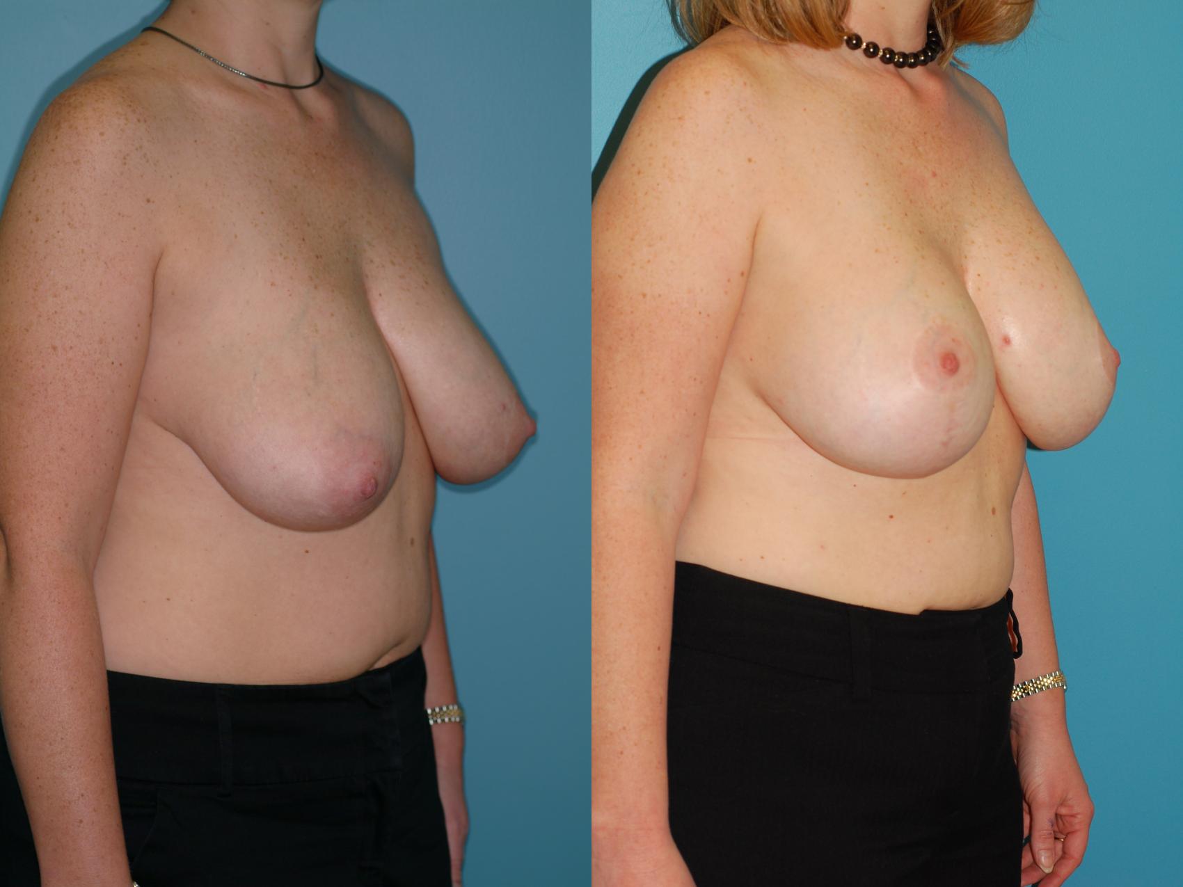 Before & After Standard Breast Lift with Implants Case 28 View #2 View in Ellicott City, MD
