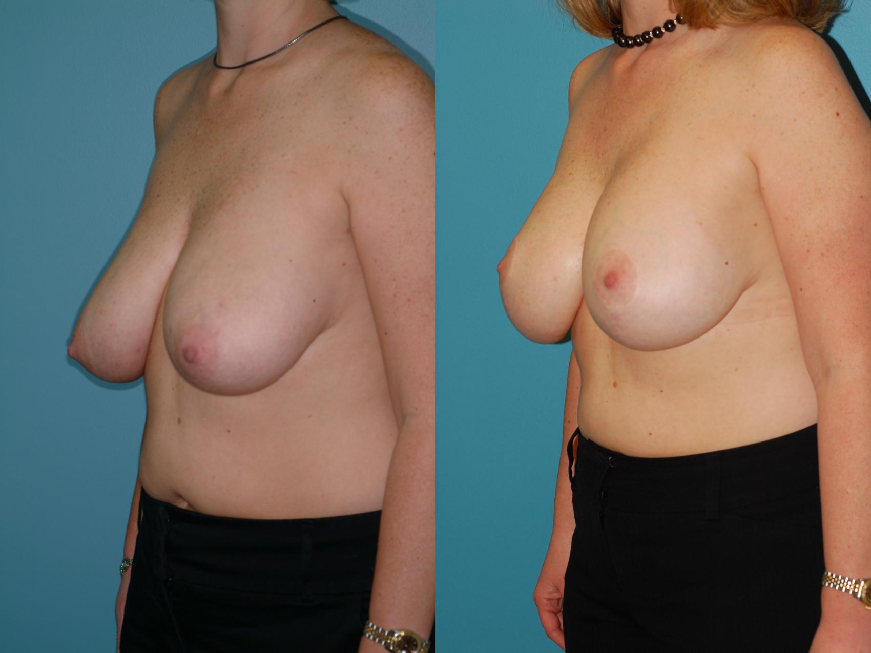 Before & After Standard Breast Lift with Implants Case 28 View #3 View in Ellicott City, MD