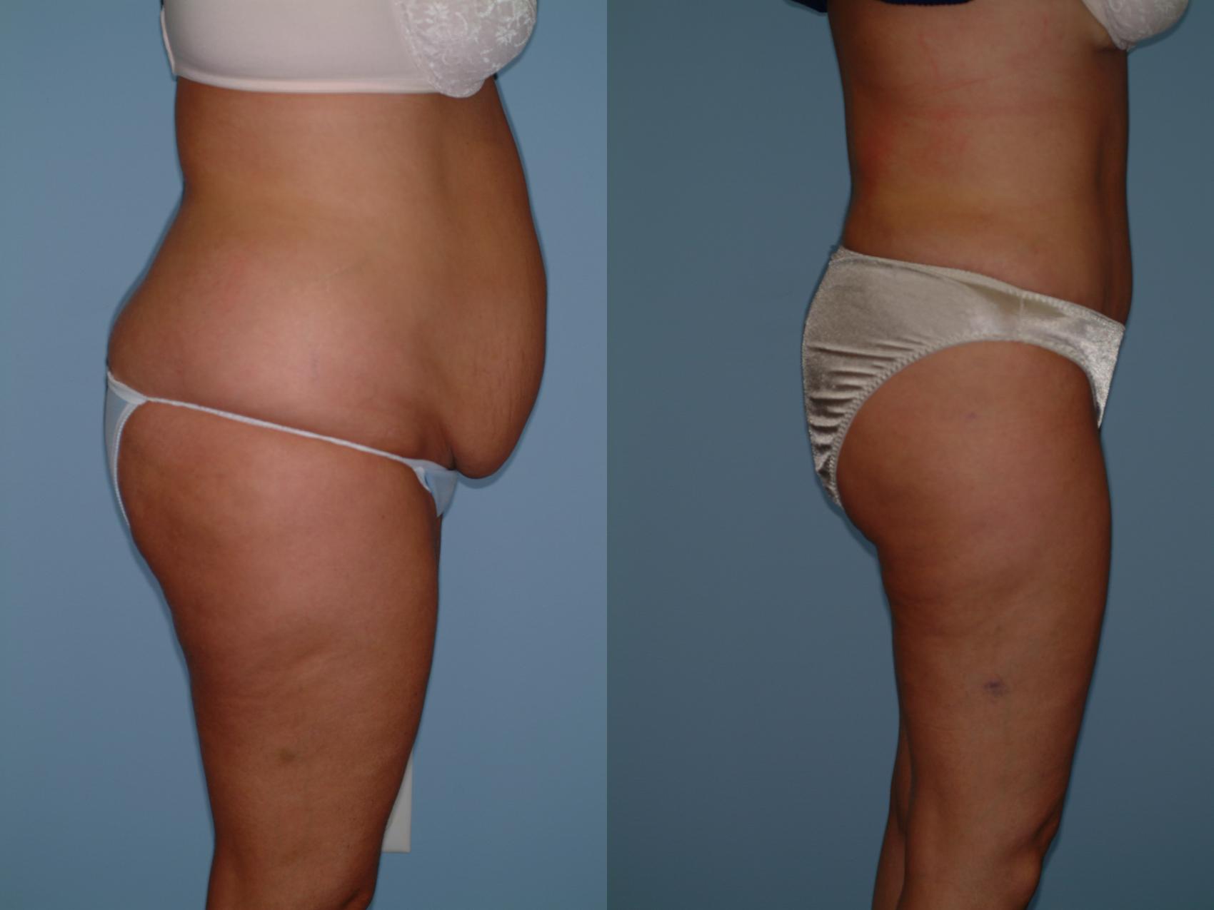 Before & After Liposuction Case 1 View #1 View in Ellicott City, MD