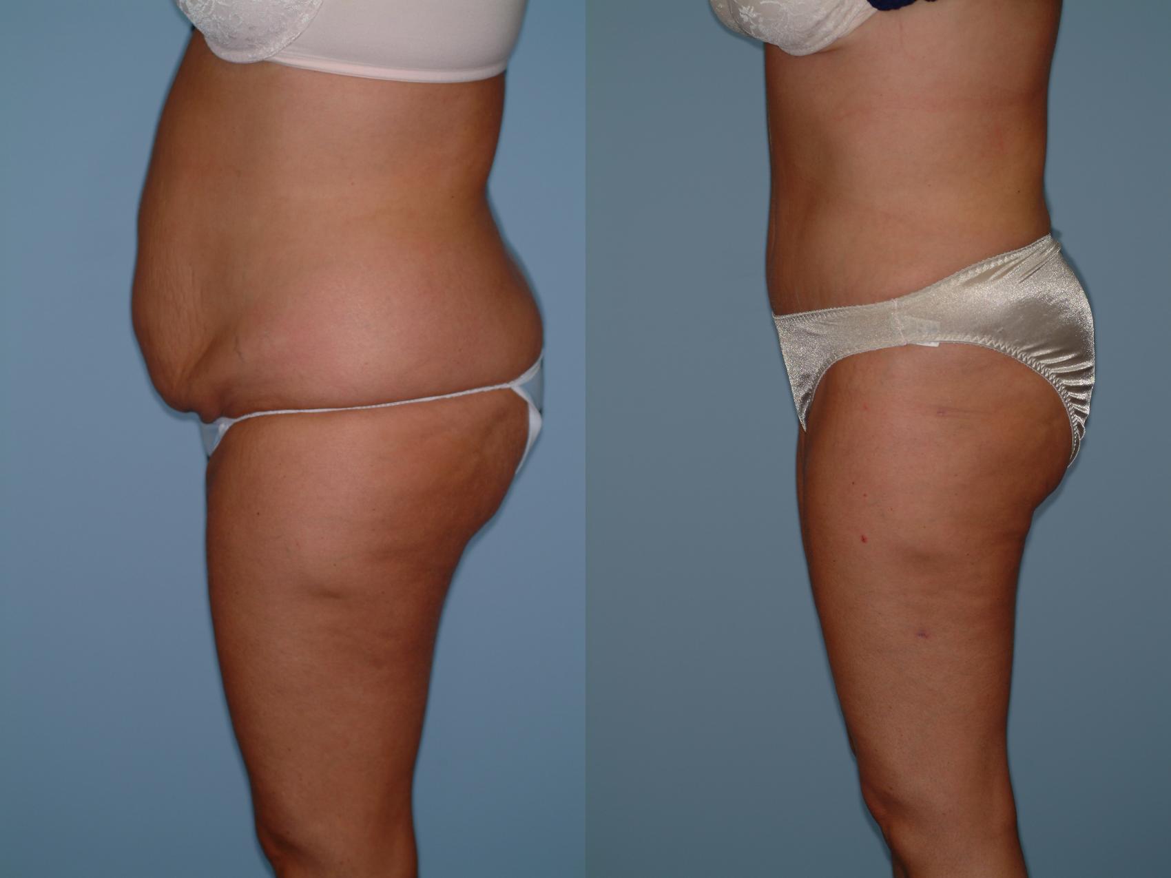 Before & After Tummy Tuck Case 1 View #2 View in Ellicott City, MD