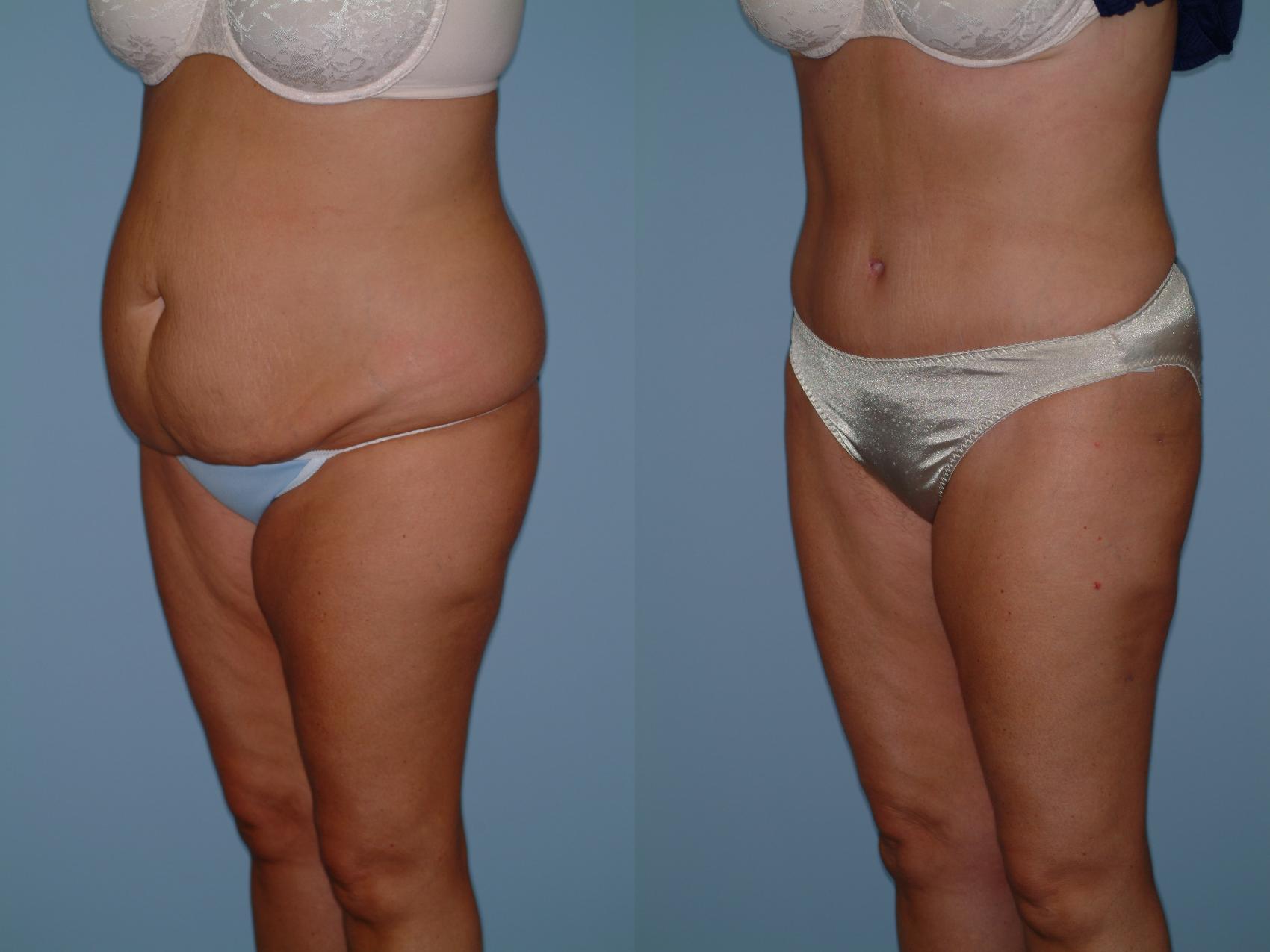 Before & After Tummy Tuck Case 1 View #3 View in Ellicott City, MD