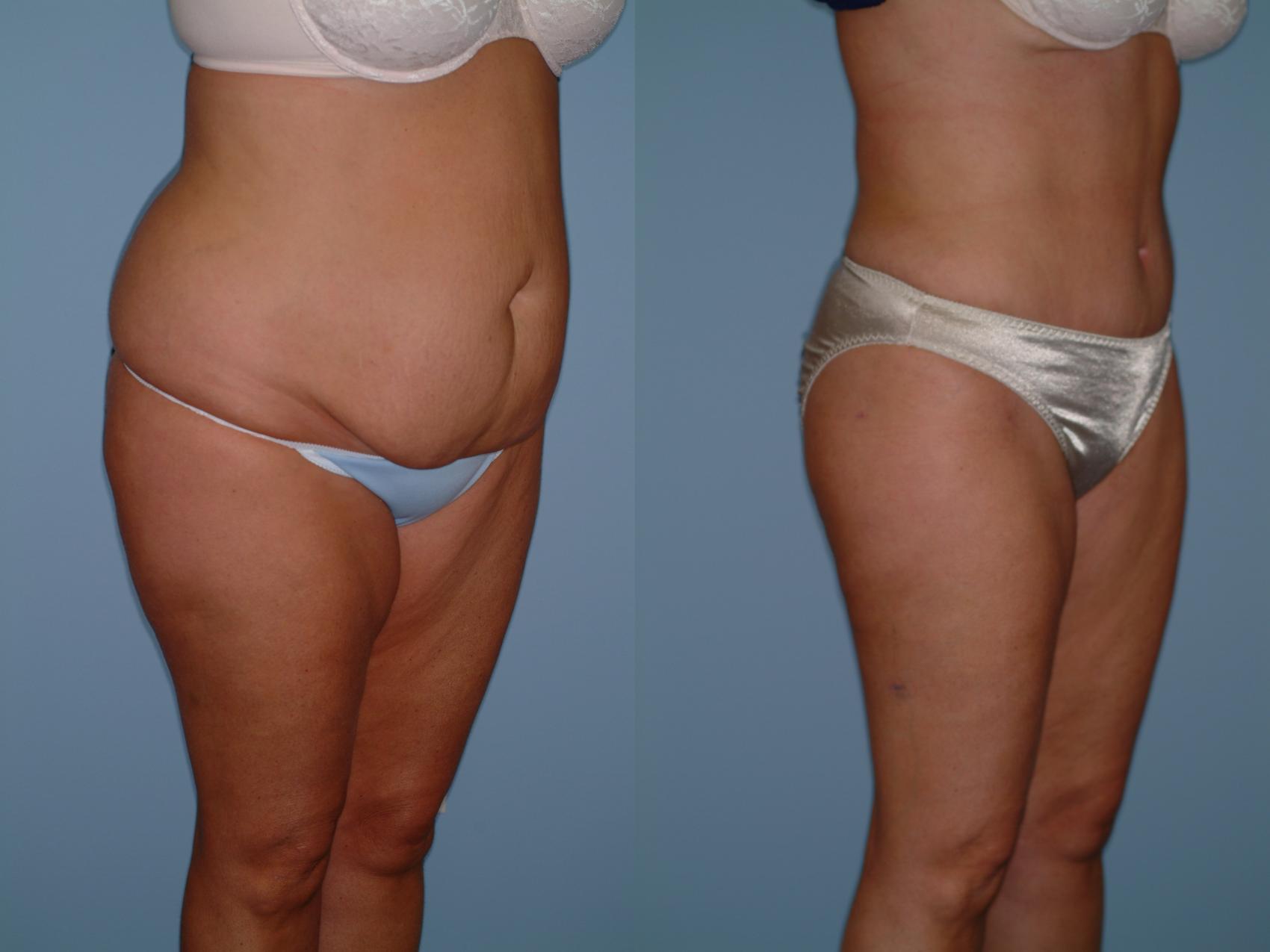 Before & After Tummy Tuck Case 1 View #4 View in Ellicott City, MD