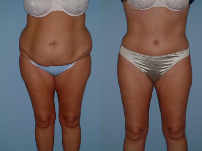 Before & After Tummy Tuck Case 1 View #5 View in Ellicott City, MD