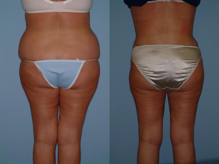 Before & After Tummy Tuck Case 1 View #6 View in Ellicott City, MD