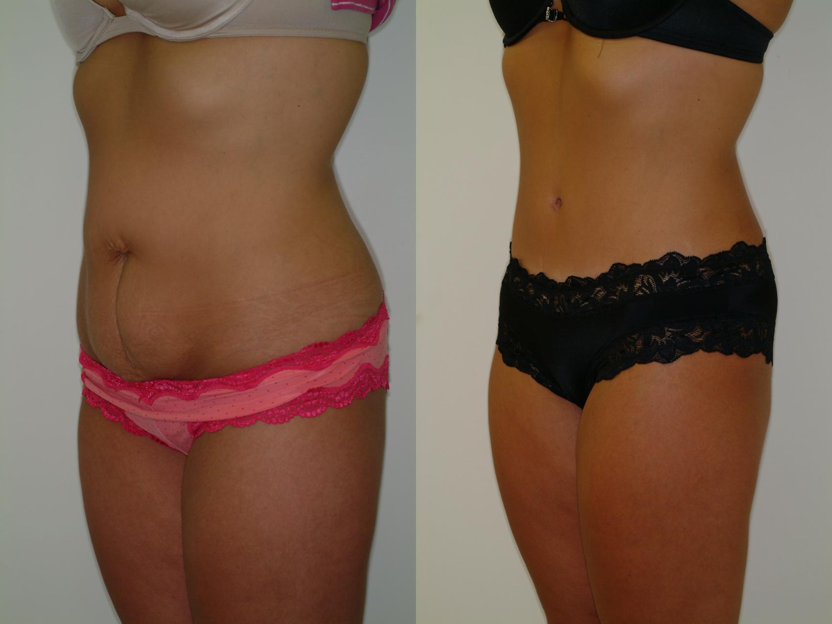 Before & After Tummy Tuck Case 2 View #1 View in Ellicott City, MD