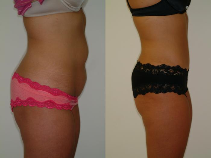 Before & After Tummy Tuck Case 2 View #2 View in Ellicott City, MD