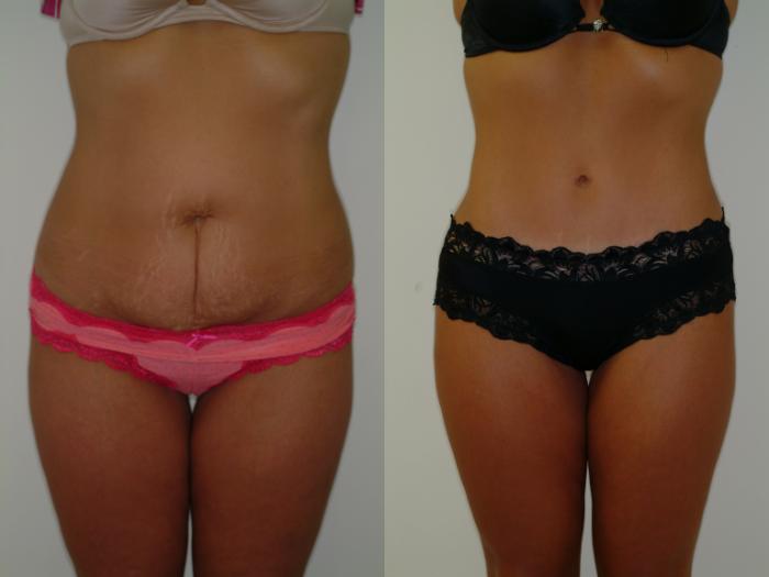 Before & After Tummy Tuck Case 2 View #3 View in Ellicott City, MD