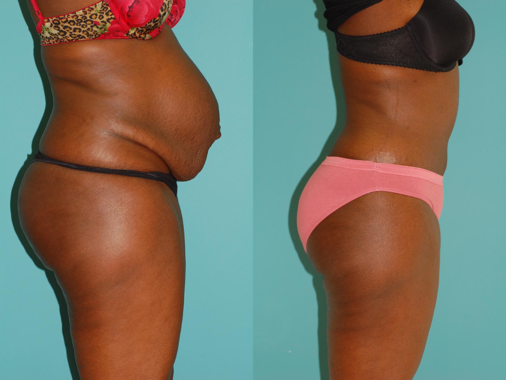 Before & After Tummy Tuck Case 22 View #1 View in Ellicott City, MD