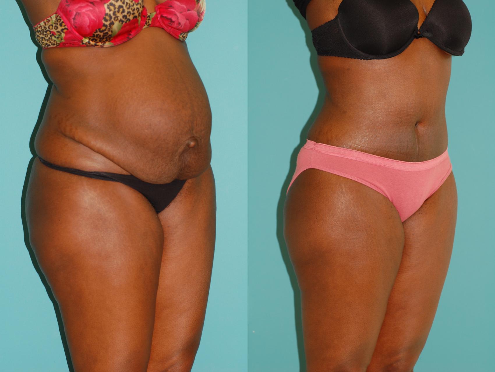 Before & After Tummy Tuck Case 22 View #2 View in Ellicott City, MD