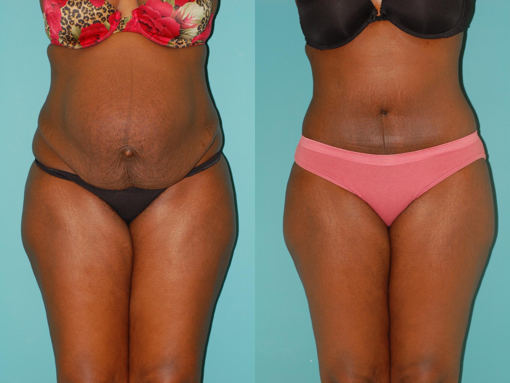 Before & After Tummy Tuck Case 22 View #3 View in Ellicott City, MD