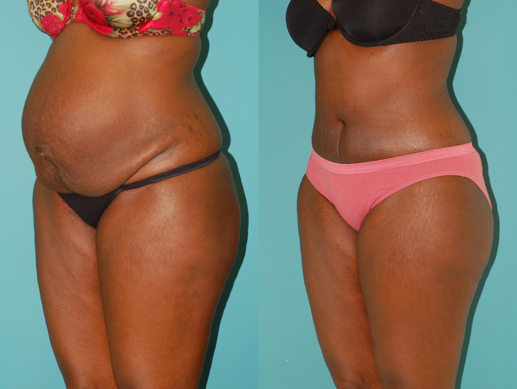 Before & After Tummy Tuck Case 22 View #4 View in Ellicott City, MD