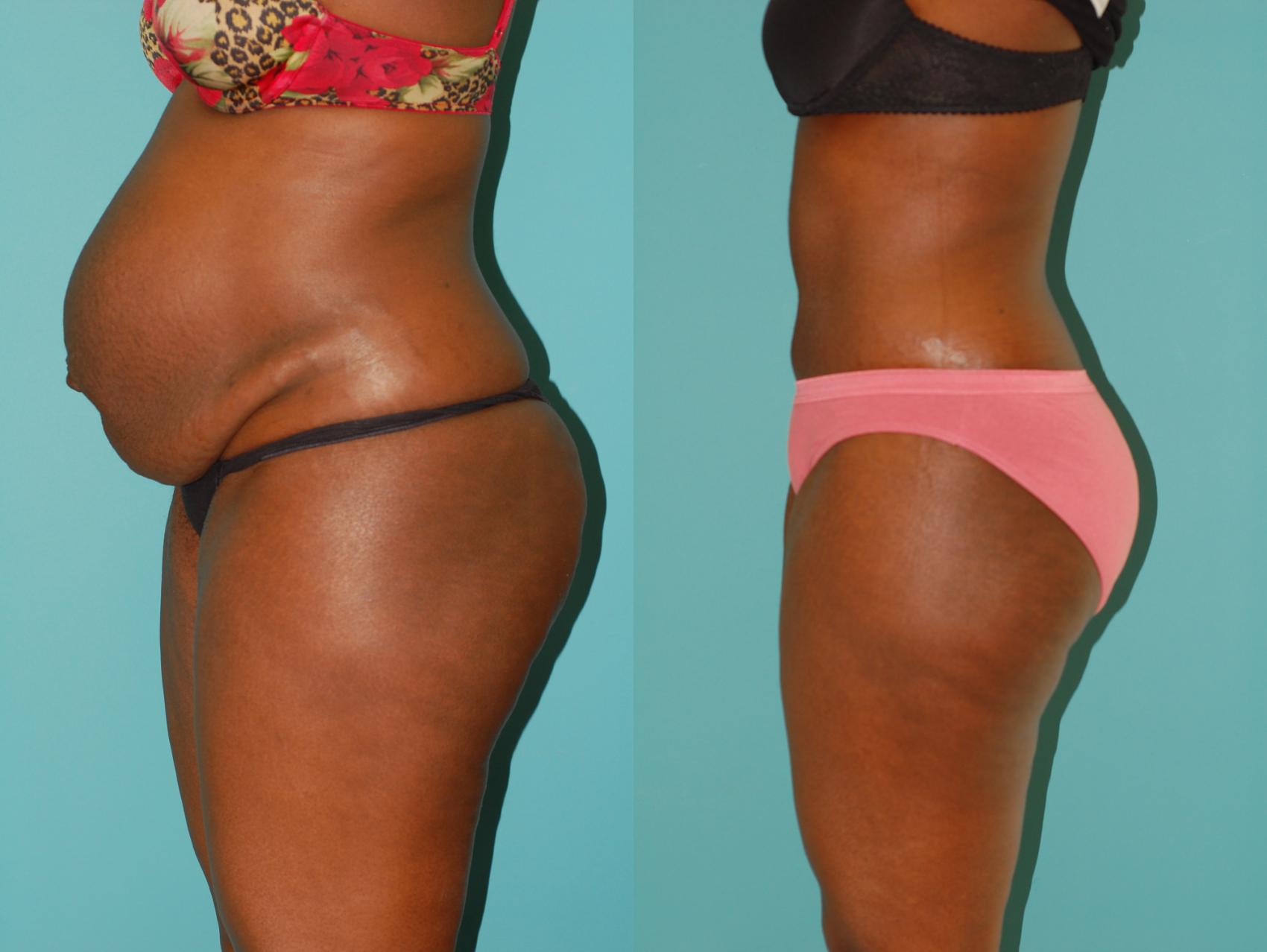 Before & After Tummy Tuck Case 22 View #5 View in Ellicott City, MD