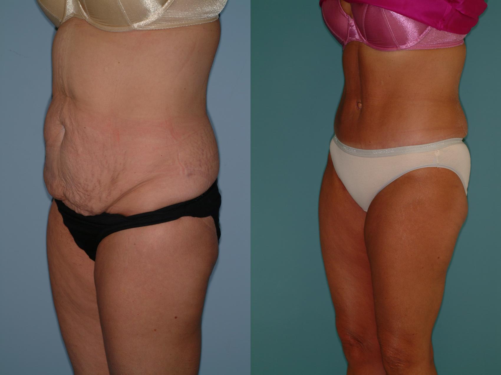 Before & After Tummy Tuck Case 23 View #1 View in Ellicott City, MD