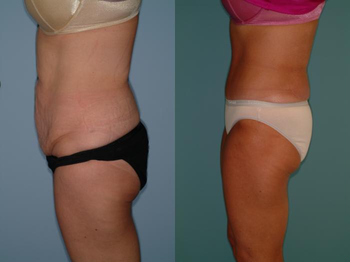 Before & After Tummy Tuck Case 23 View #2 View in Ellicott City, MD