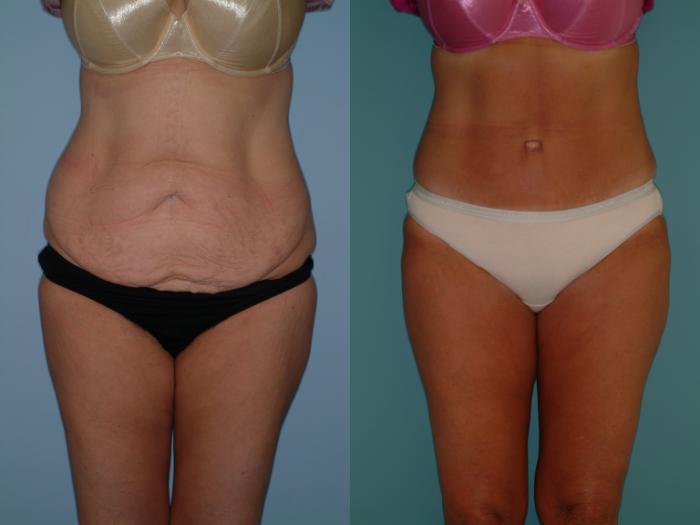 Before & After Tummy Tuck Case 23 View #3 View in Ellicott City, MD