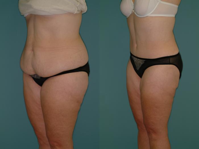 Before & After Tummy Tuck Case 3 View #1 View in Ellicott City, MD