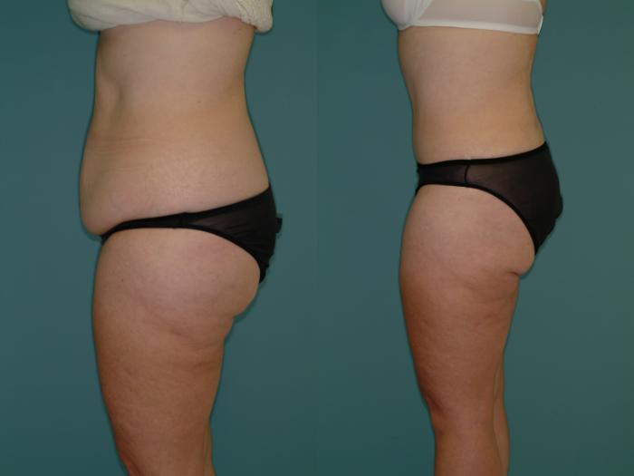 Before & After Tummy Tuck Case 3 View #2 View in Ellicott City, MD