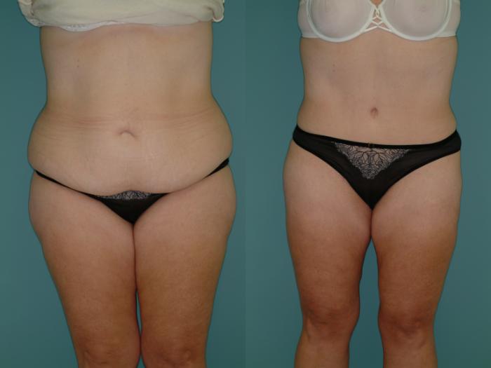 Before & After Tummy Tuck Case 3 View #3 View in Ellicott City, MD