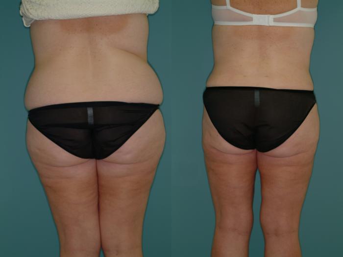 Before & After Tummy Tuck Case 3 View #4 View in Ellicott City, MD