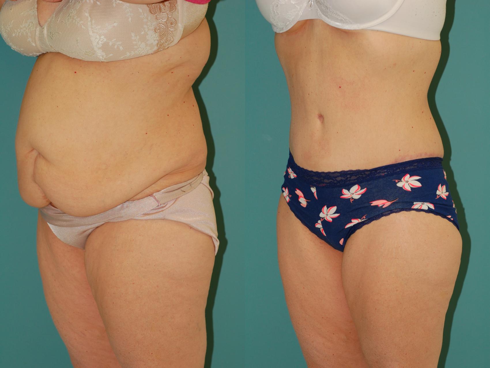 Before & After Tummy Tuck Case 43 View #1 View in Ellicott City, MD