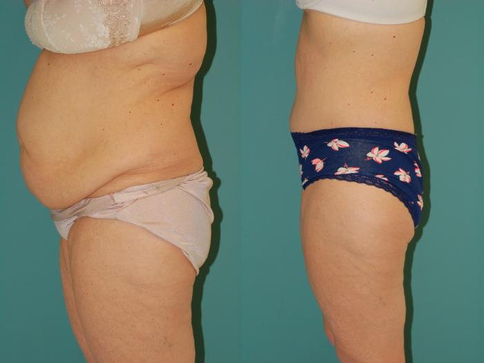 Before & After Tummy Tuck Case 43 View #2 View in Ellicott City, MD