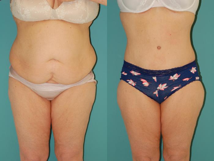 Before & After Tummy Tuck Case 43 View #3 View in Ellicott City, MD