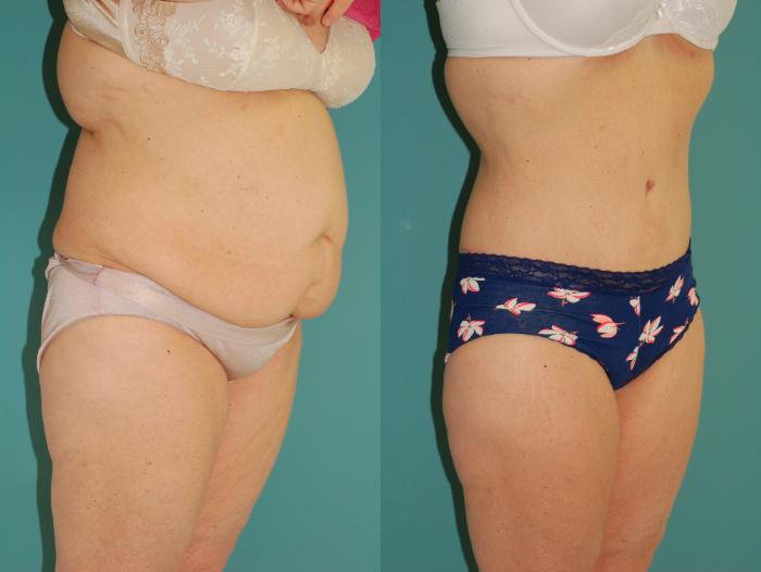 Before & After Tummy Tuck Case 43 View #4 View in Ellicott City, MD