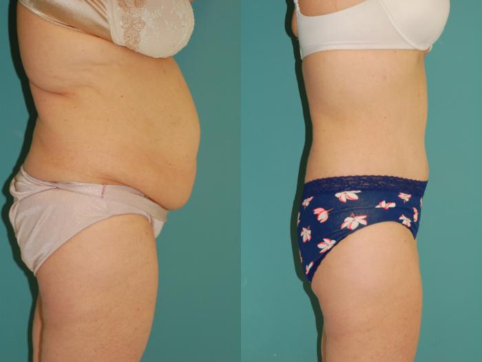 Before & After Tummy Tuck Case 43 View #5 View in Ellicott City, MD