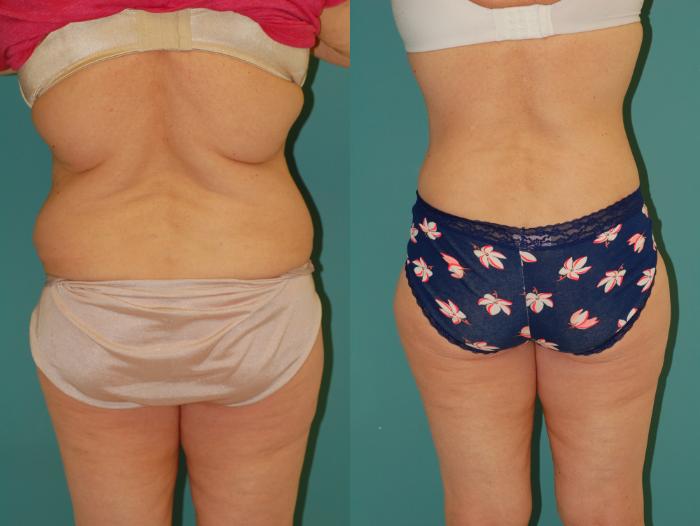 Before & After Tummy Tuck Case 43 View #6 View in Ellicott City, MD